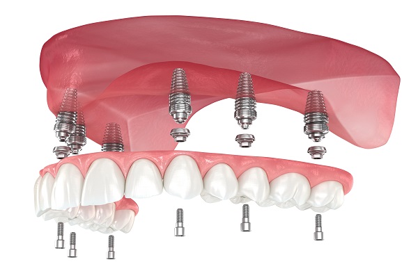 Implant Supported Dentures Rego Park, NY